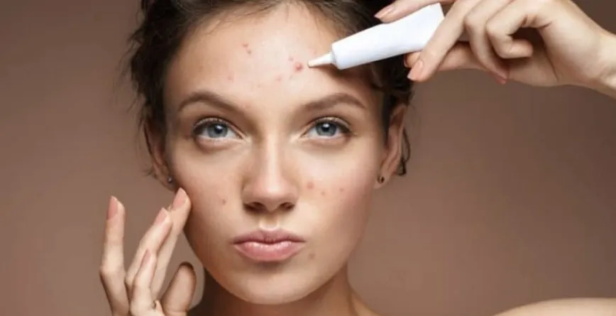 Gel thiên nhiên: Kháng nấm trị mụn Malassezia