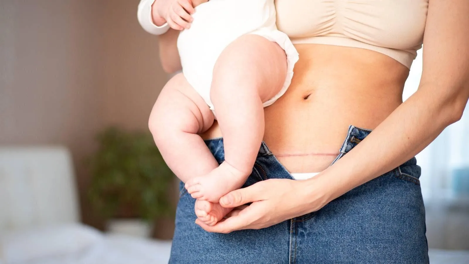 Sẹo mổ đẻ: 7 nguyên tắc vàng thẩm mỹ