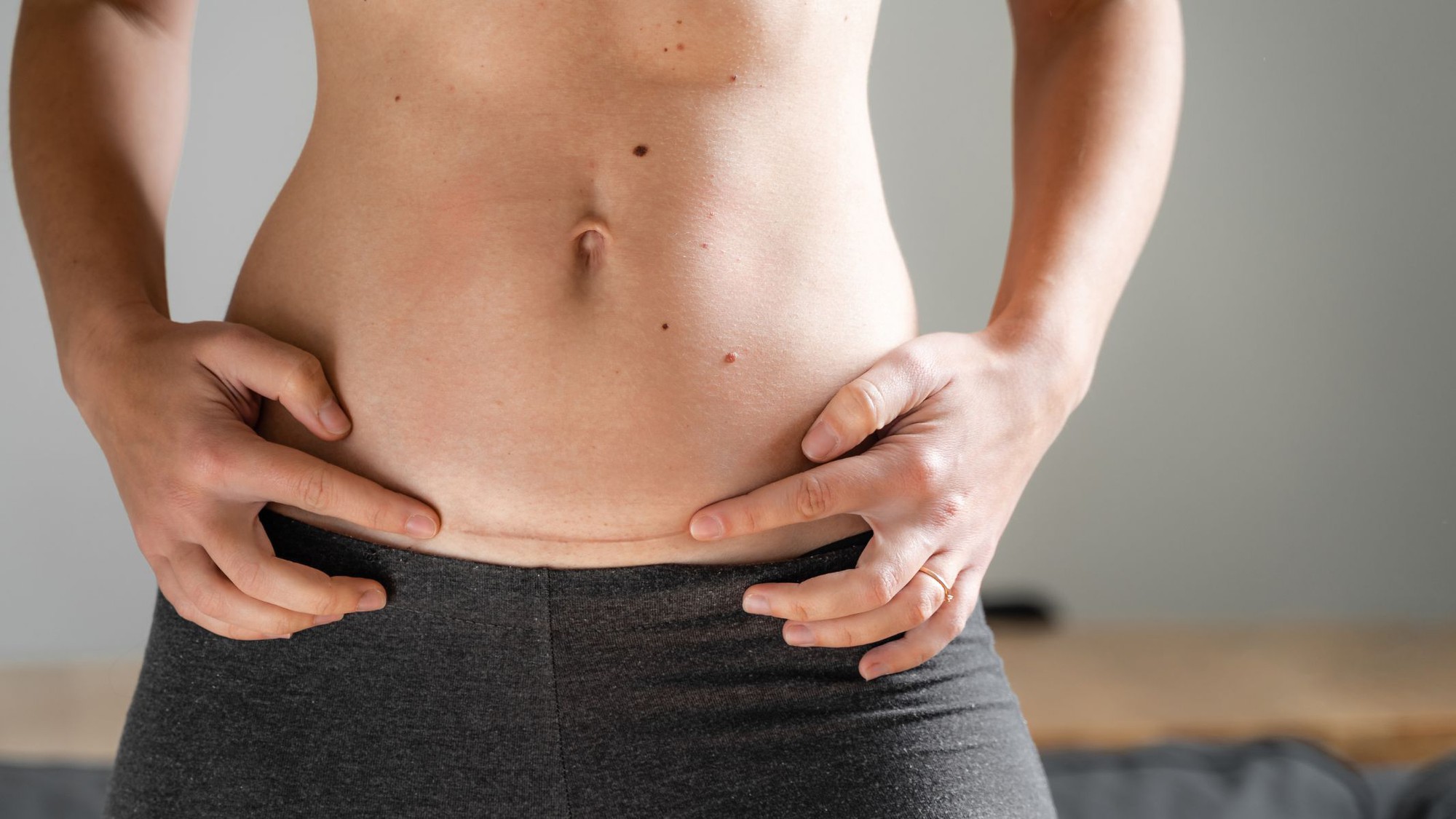 Vẫn biết phần lớn là do cơ địa, thế nhưng làm sao để vết sẹo mổ đẻ 